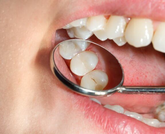Closeup of smile after dental sealants are placed