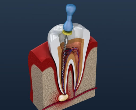 Animated tooth during root canal pulp treatment