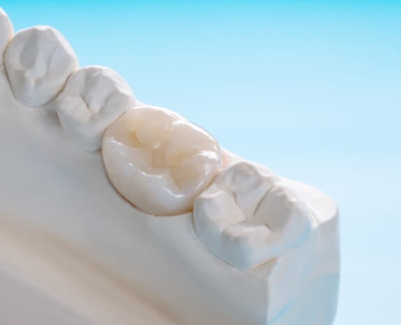 Model smile with dental crown restoration