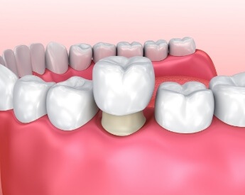 Animated smile during dental crown placement