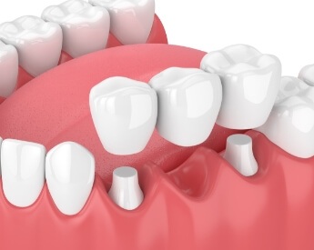 Animated smile during dental bridge placement