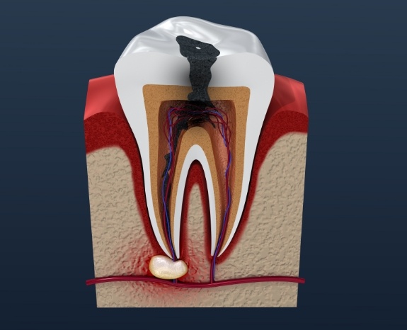 Animated tooth with severe decay and damage before root canal treatment