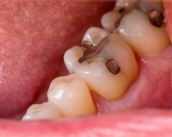 Closeup of teeth with silver fillings