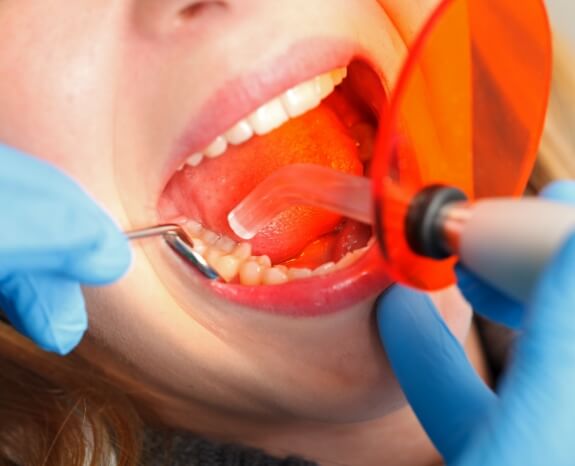 Dental patient receiving tooth colored fillings