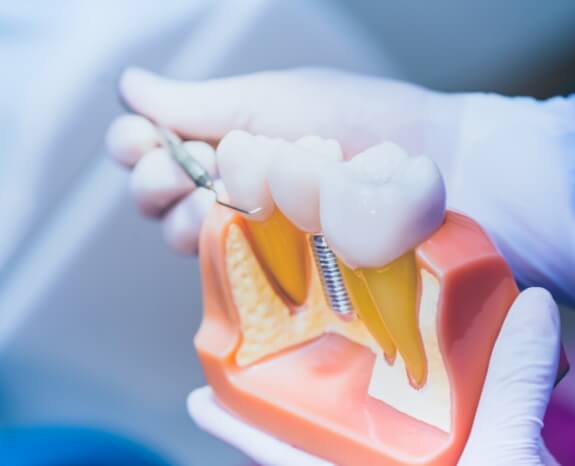 Model comparing dental implants to natural teeth