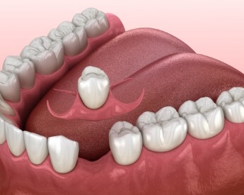 Animated smile during dental implant supported dental crown placement