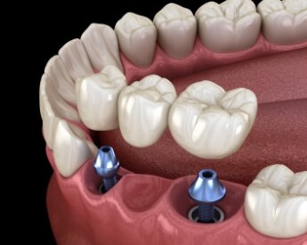 Animated smile during dental implant supported fixed bridge placement