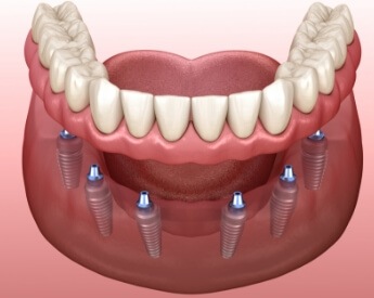 Animated smile during dental implant supported denture placement