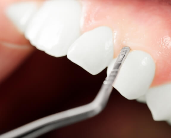 Closeup of smile during gum recontouring treatment