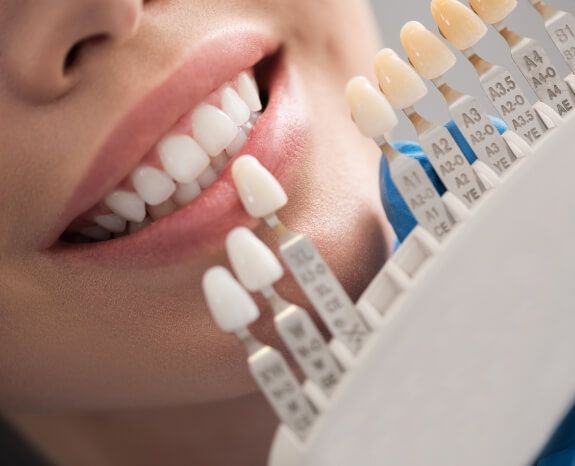 Smile compared with tooth colored filling shade chart