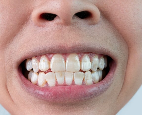 Closeup of smile with discolored teeth